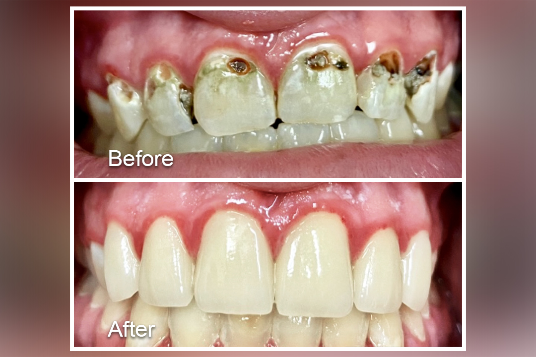 Holes teeth to clean