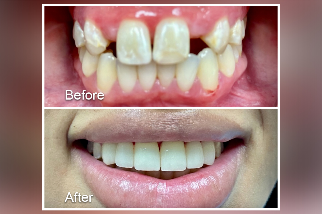 Damages Teeth to new