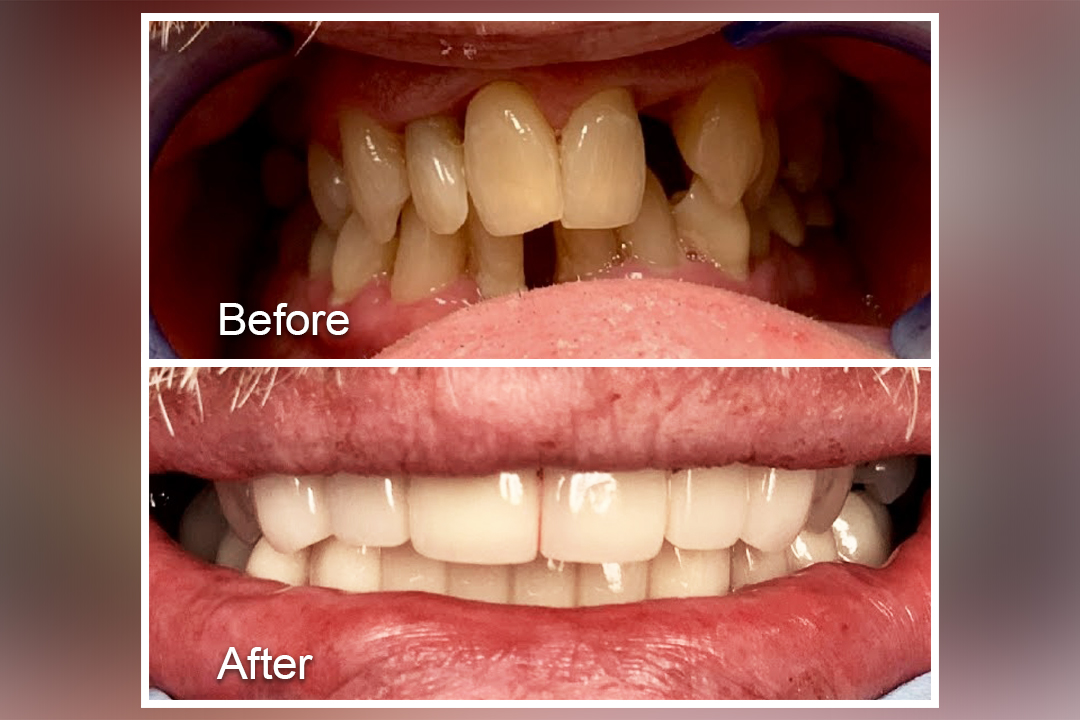 Crooked teeth replaced with dentures