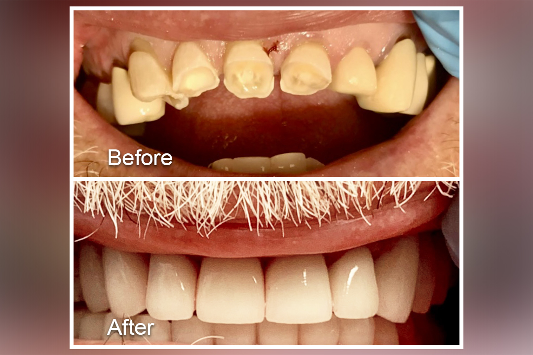 Worn teeth restored with crowns