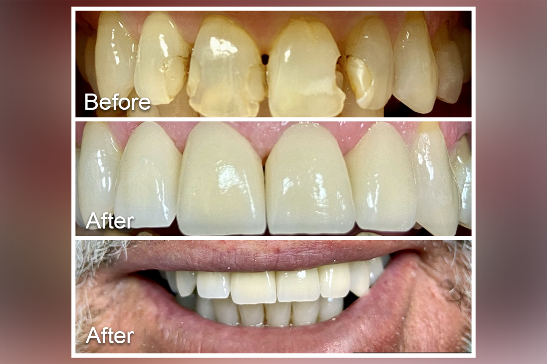 Damaged to restored white teeth