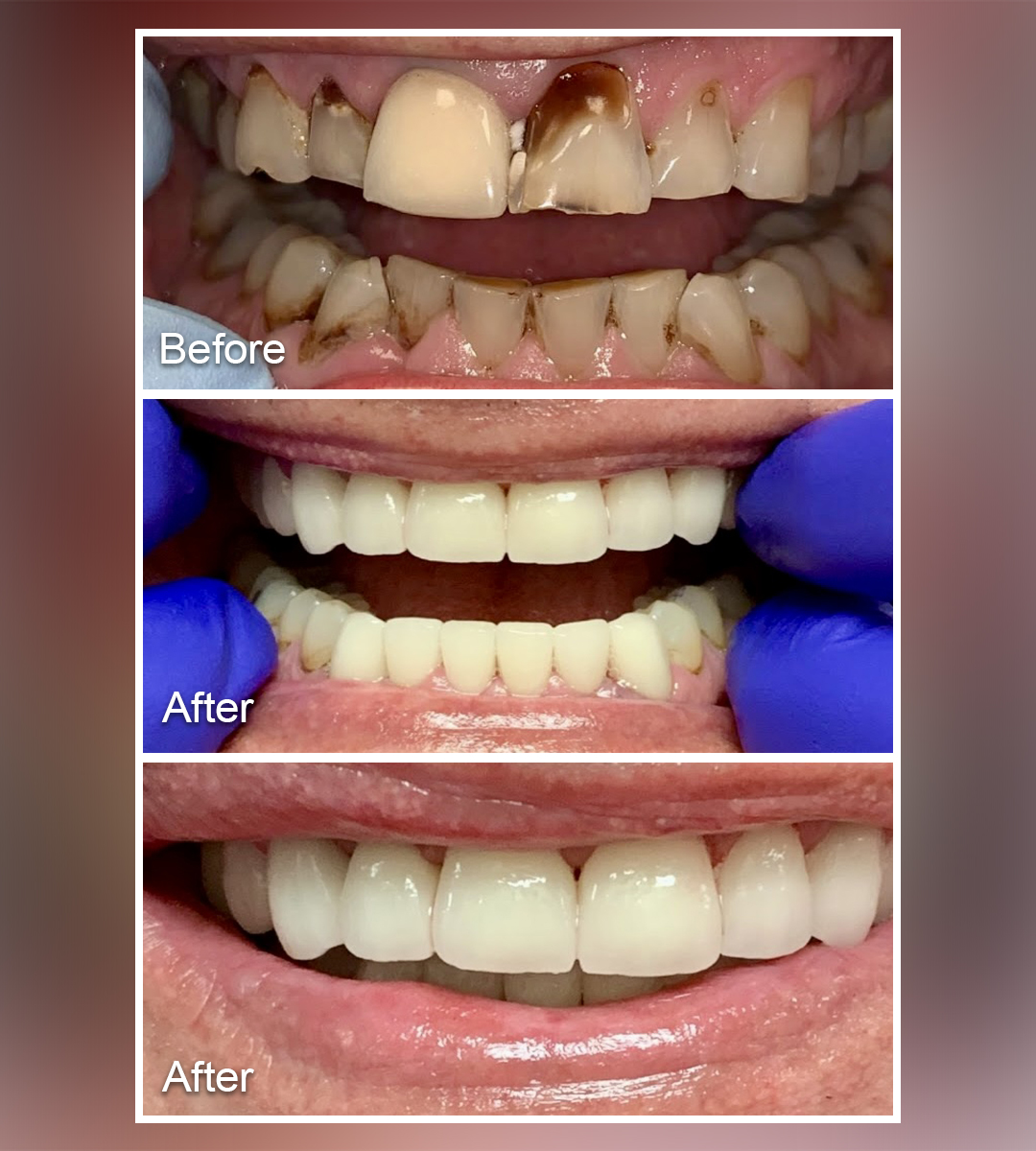 Before and After Teeth