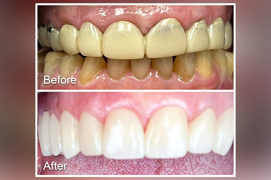 tartar to healthy tooth