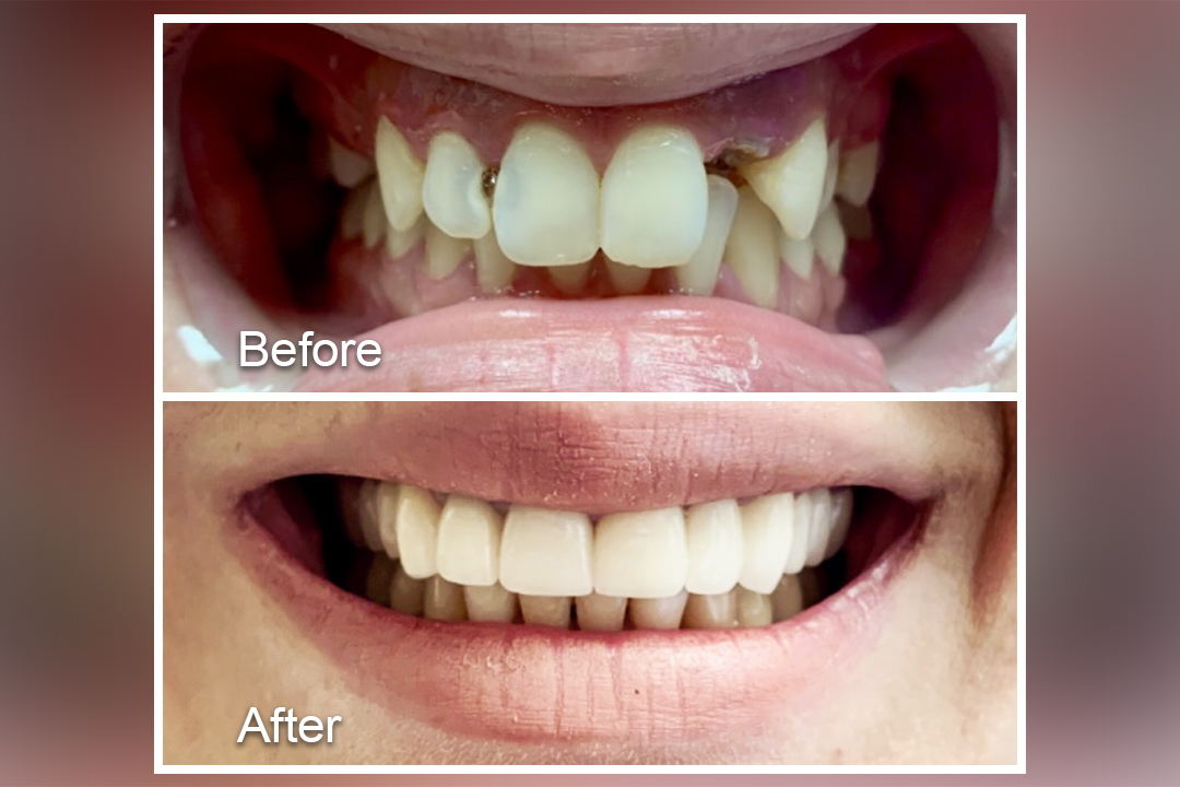 Worn teeth to white
