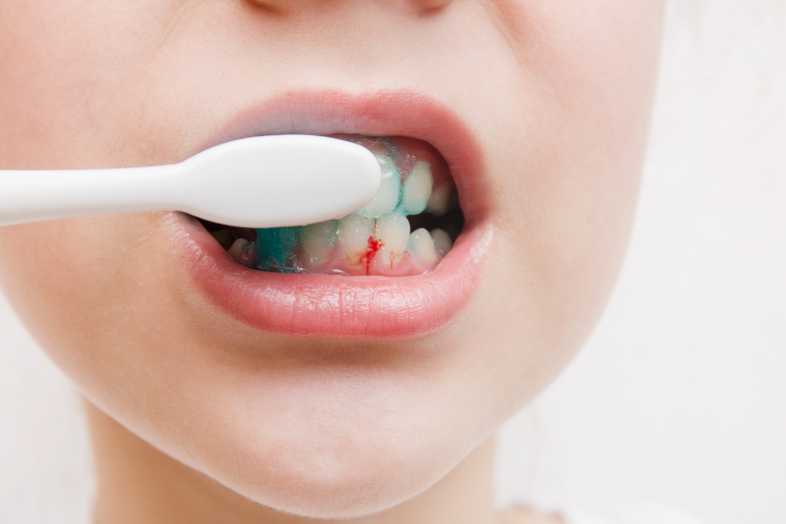 Bleeding at teeth during brushing with toothbrush.scurvy
